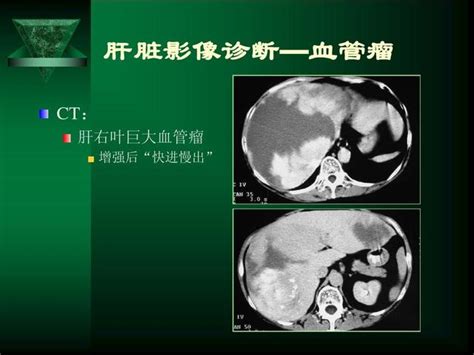 肝長東西|肝臟長了東西 不一定是「歹咪呀」 ∣ 羅東博愛醫院